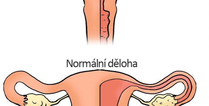 Dvourohá (srdcovitá) děloha a těhotenství