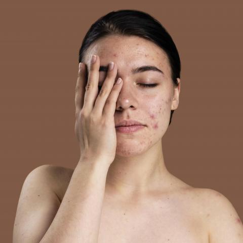 Akné
